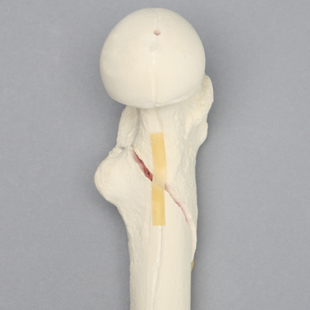 Femur with Subtrochanteric Spiral Fracture
