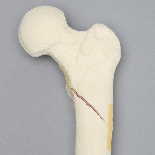 Femur with Subtrochanteric Spiral Fracture