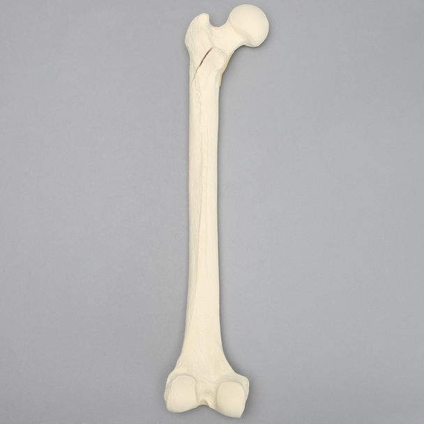 Femur with Subtrochanteric Spiral Fracture