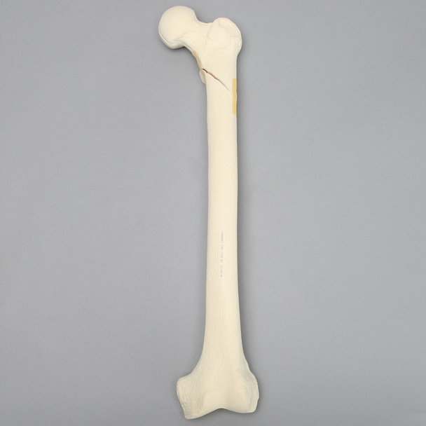 Femur with Subtrochanteric Spiral Fracture