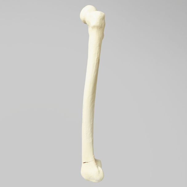 Femur with Transverse Fracture and Fragment