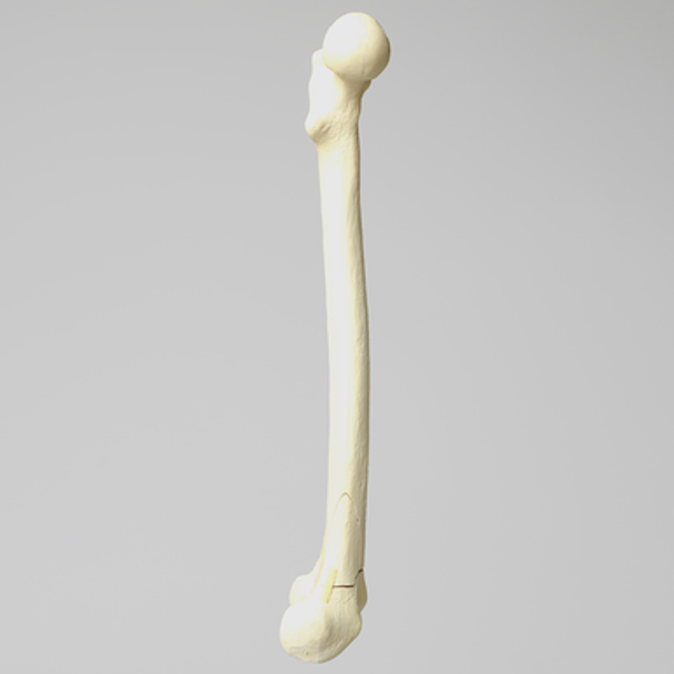 Femur with Transverse Fracture and Fragment
