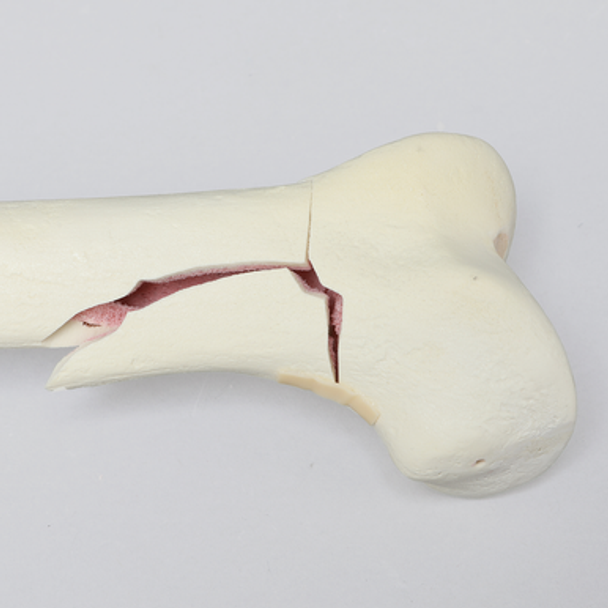 Femur with Transverse Fracture and Fragment