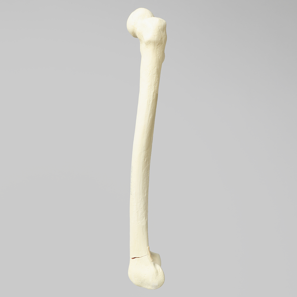 Femur with Transverse Fracture and Fragment