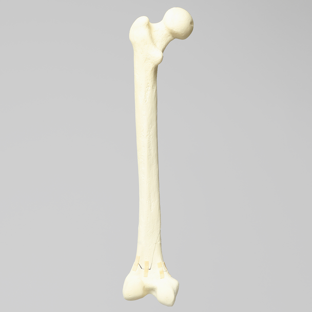 Femur with Transverse Fracture and Fragment