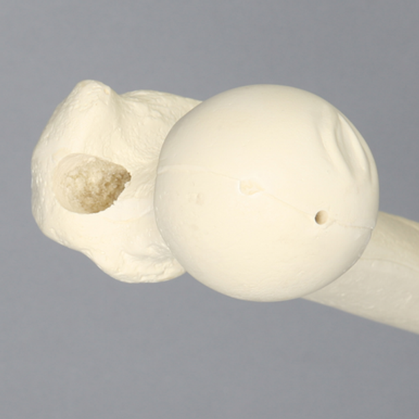 Femur with 16 mm For IM Nail