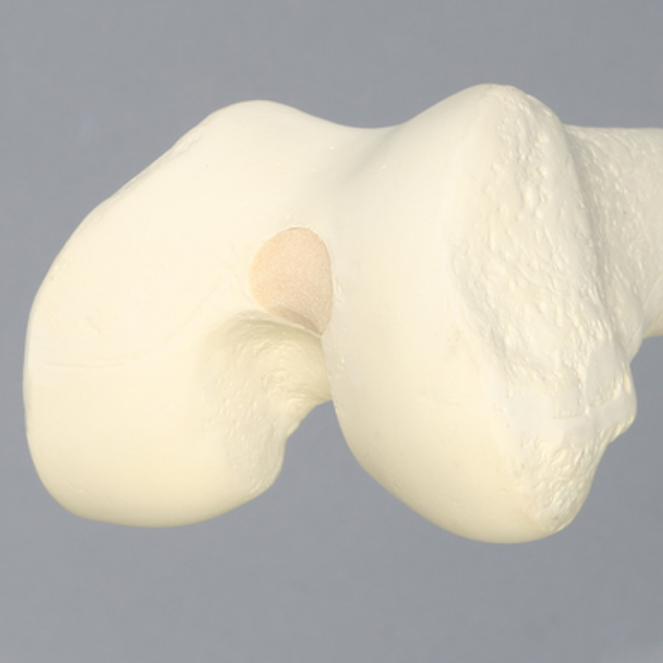 Femur with 16 mm For IM Nail