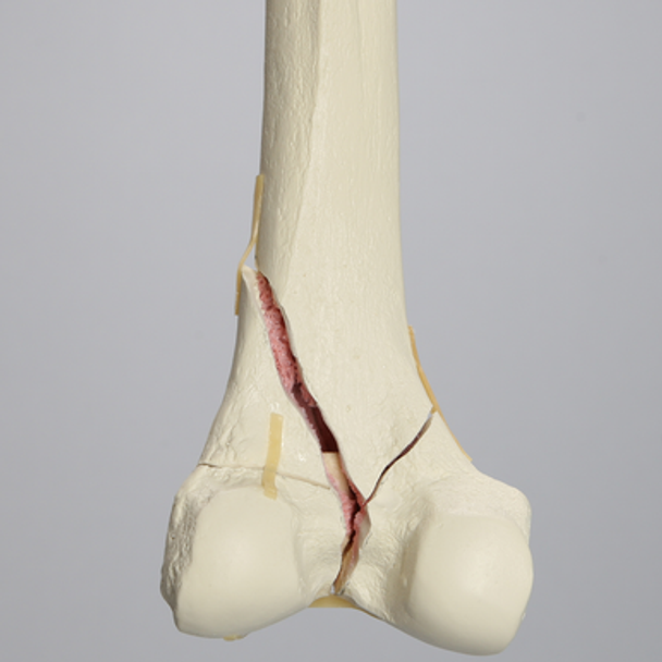 Femur with Bicondylar and Congenital Fractures