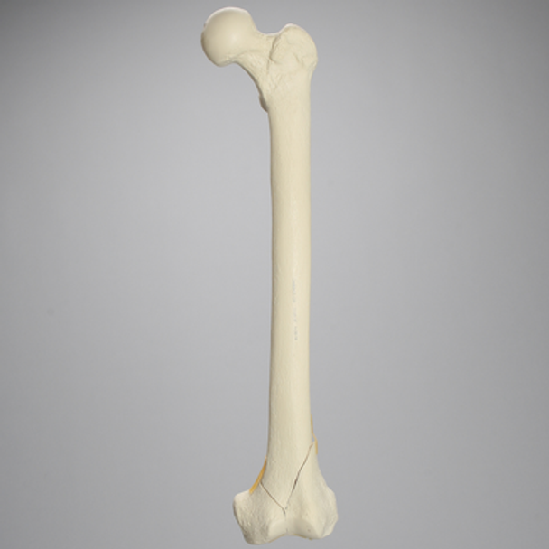 Femur with Bicondylar and Congenital Fractures