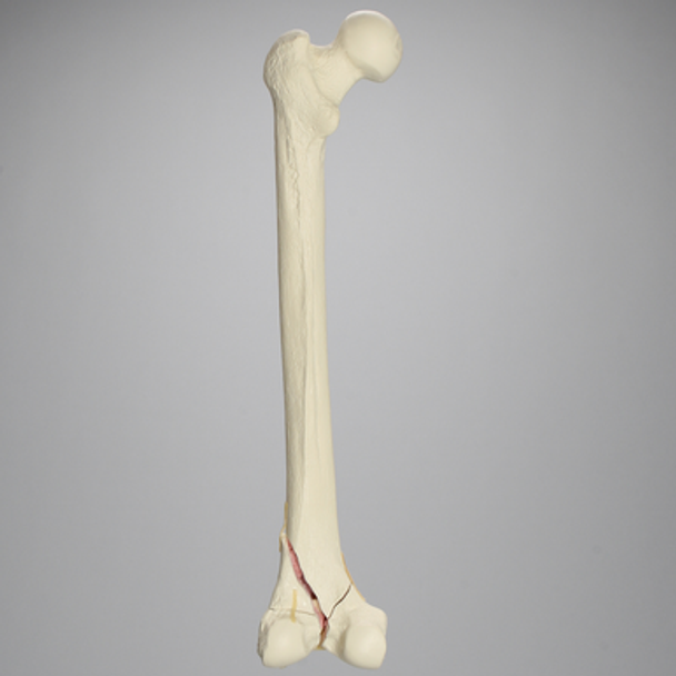 Femur with Bicondylar and Congenital Fractures