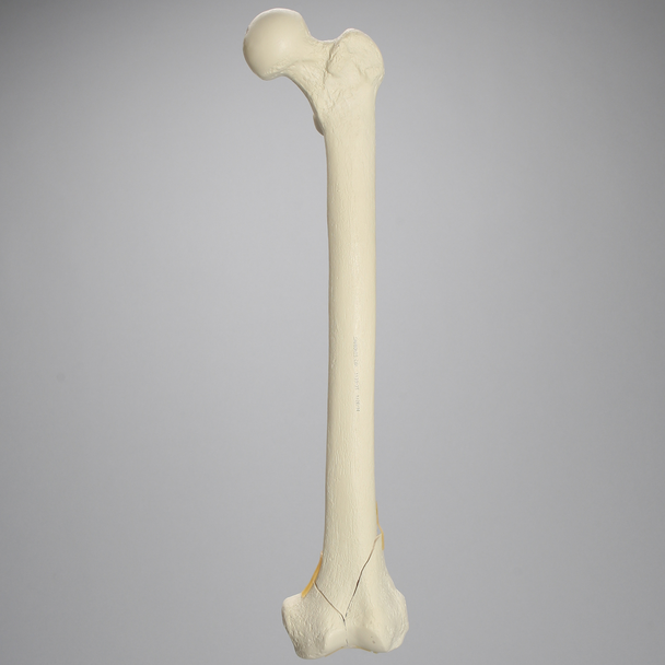 Femur with Bicondylar and Congenital Fractures