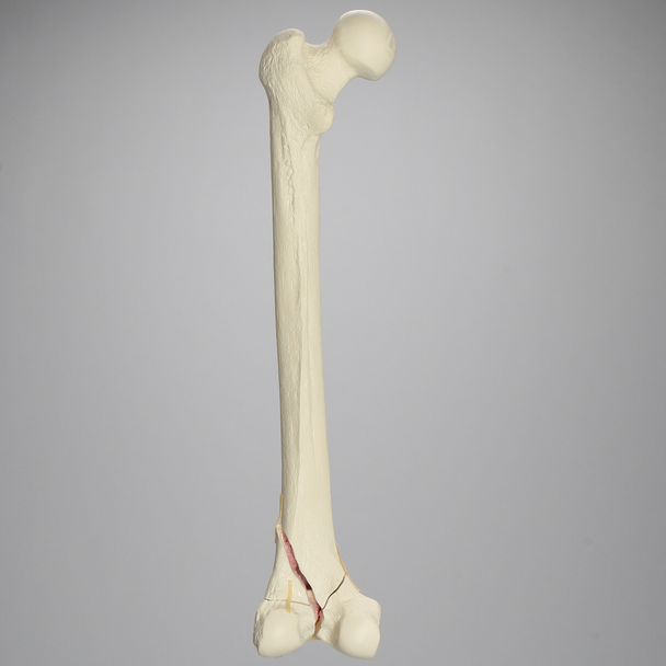 Femur with Bicondylar and Congenital Fractures