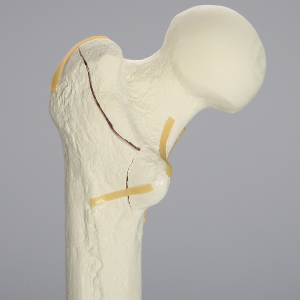 Femur with Intertrochanteric Fracture with Fragment