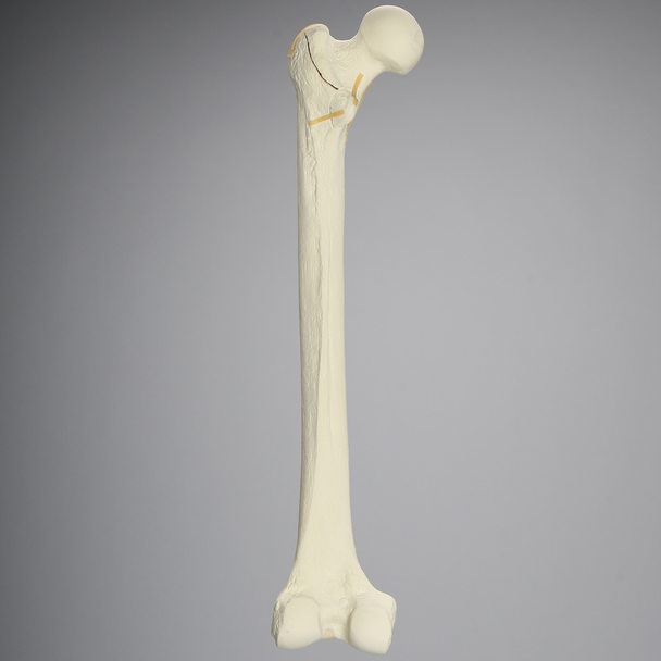 Femur with Intertrochanteric Fracture with Fragment