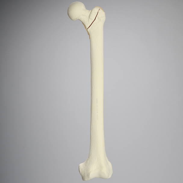 Femur with Intertrochanteric Fracture with Fragment