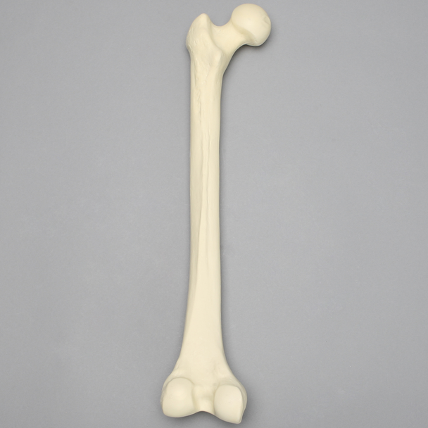 Femur with Osteoporosis, Osteoporotic Cortical Shell