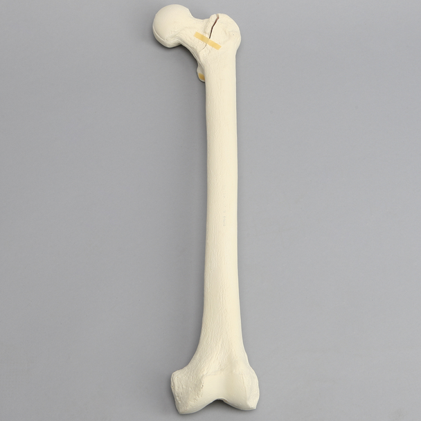 Femur with Three-Part Fracture
