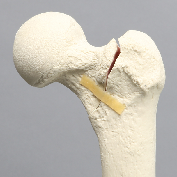 Femur with Three-Part Fracture