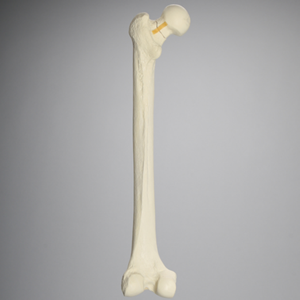 Femur with Neck Fracture