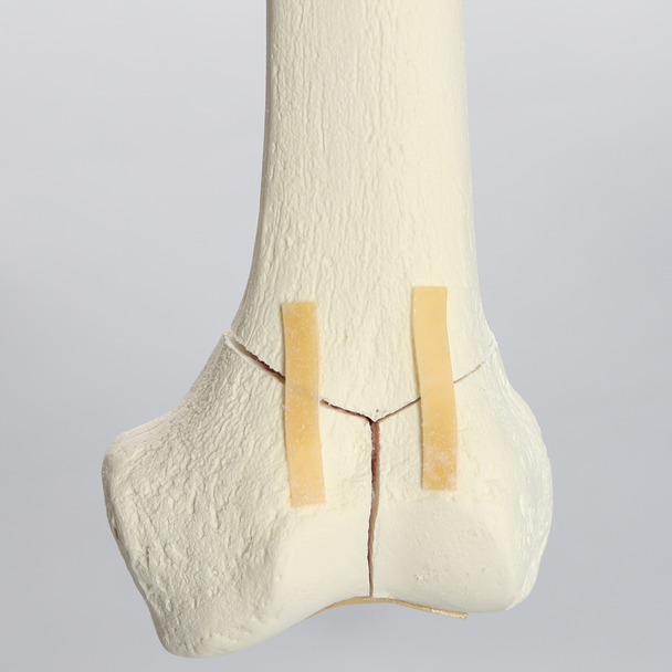 Femur with Oblique and "T" Fractures