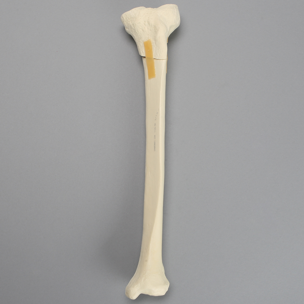 Tibia with Oblique Fracture and Hollow Core