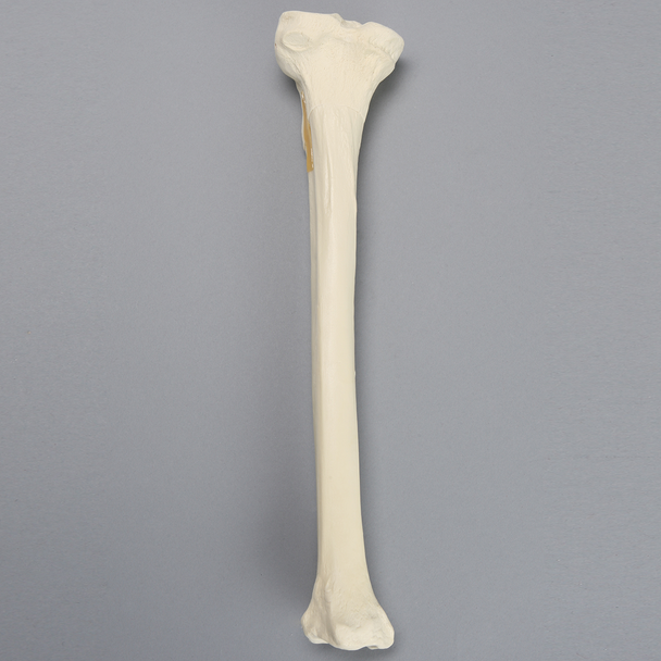 Tibia with Oblique Fracture and Hollow Core