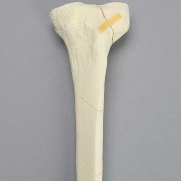 Tibia with Condylar, Oblique, and Spiral Fractures