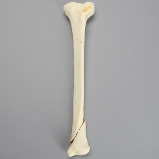 Tibia with Condylar, Oblique, and Spiral Fractures
