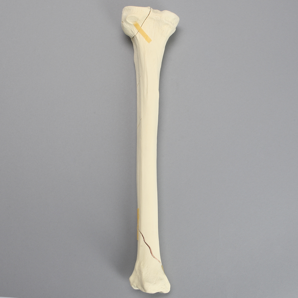Tibia with Condylar, Oblique, and Spiral Fractures