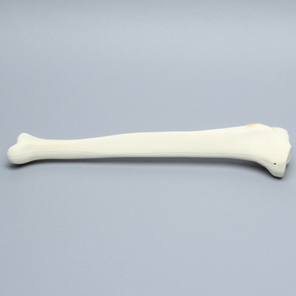 Tibia with Condylar Fracture