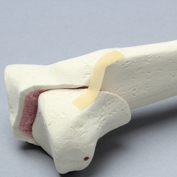 Tibia with Condylar Fracture