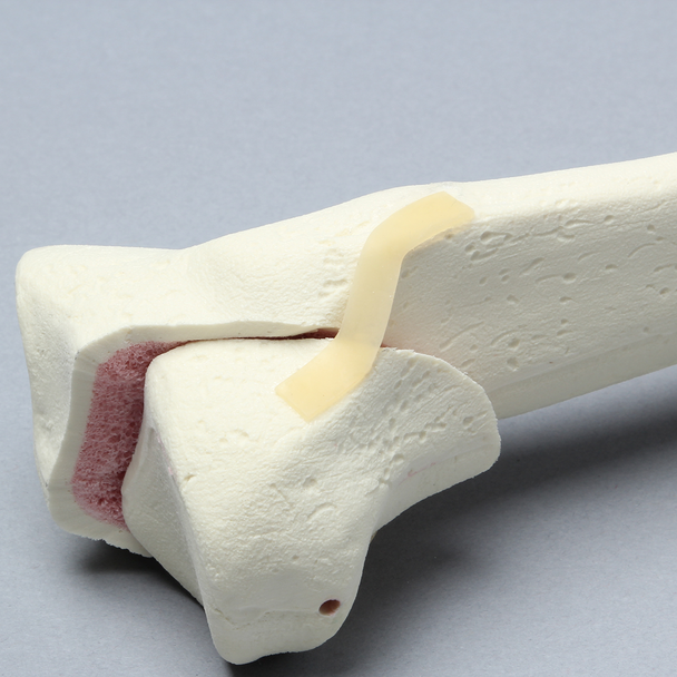 Tibia with Condylar Fracture