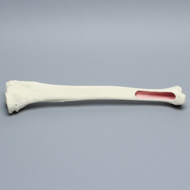 Tibia for IM Nail with Distal Window