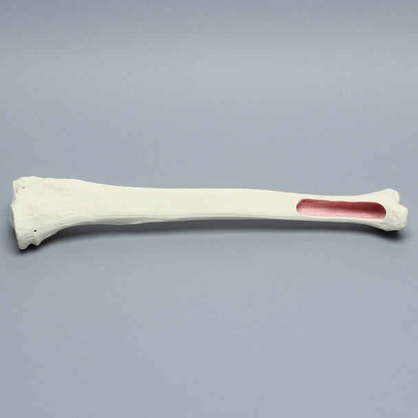 Tibia for IM Nail with Distal Window
