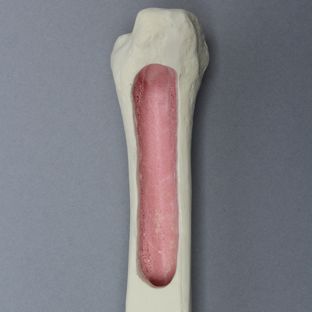 Tibia for IM Nail with Distal Window