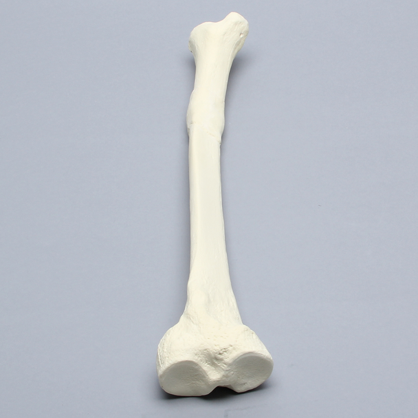 Tibia with Distal Malunion and 25 Degree Varus Defect, Foam Cortical