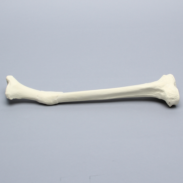 Tibia with Distal Malunion and 25 Degree Varus Defect, Foam Cortical