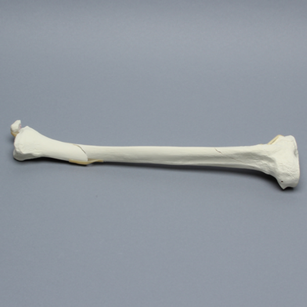 Tibia with Condylar, Malleolar, Oblique, and Spiral Fractures