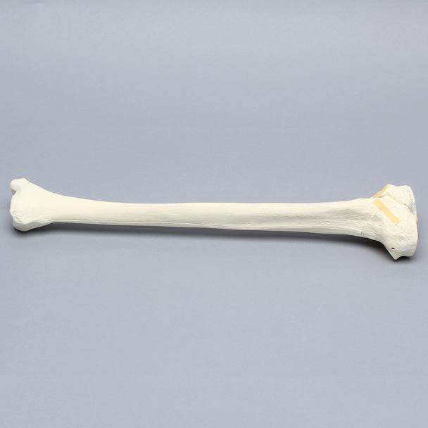 Tibia with "Y" Fracture