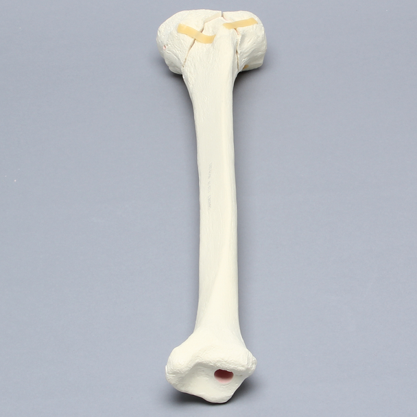 Tibia with "Y" Fracture