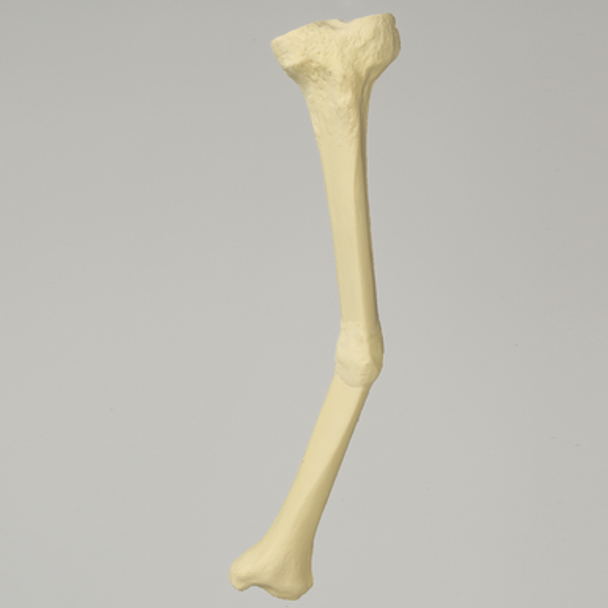 Tibia with Midshaft Malunion and 25 degree Varus Defect