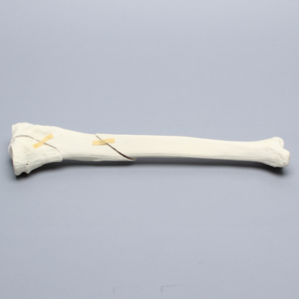 Tibia with Condylar and Oblique Fractures