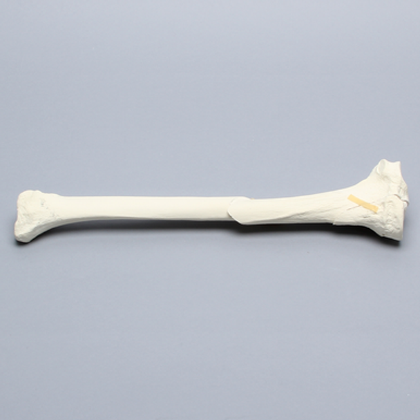 Tibia with Condylar and Oblique Fractures