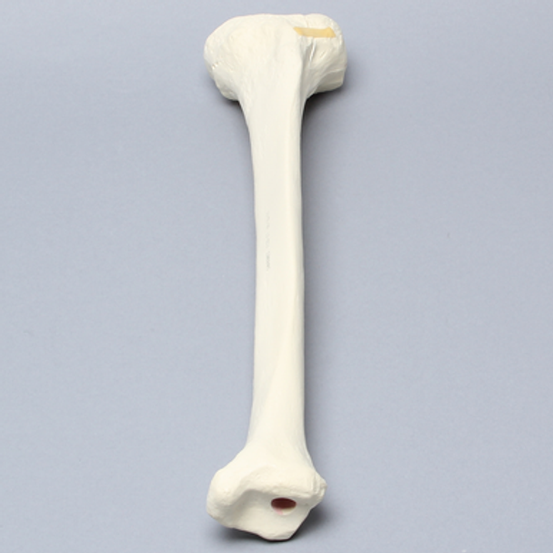 Tibia with Condylar Fracture and Fragment