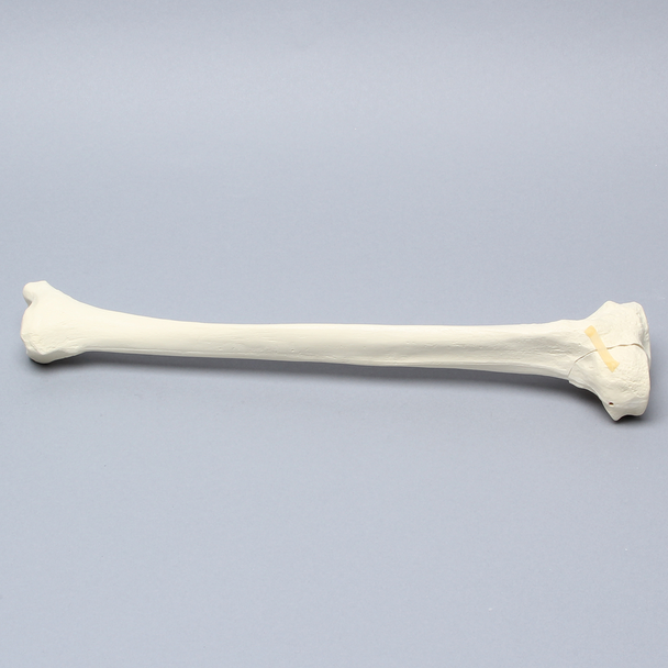 Tibia with Condylar Fracture and Fragment