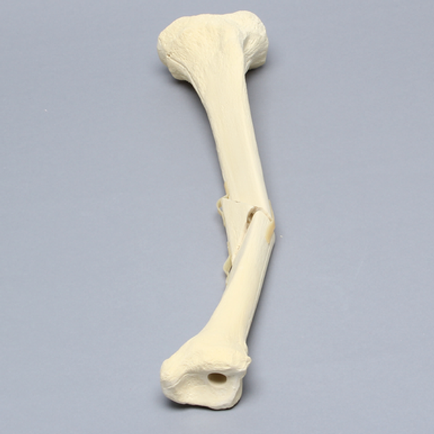Tibia with Butterfly Fracture