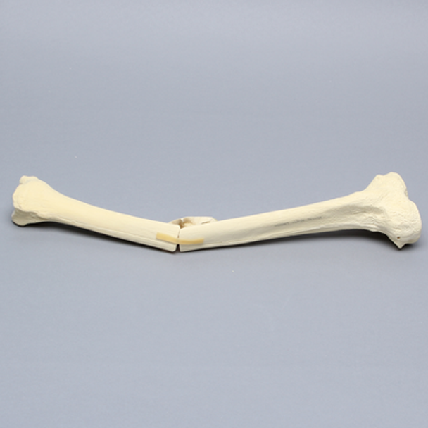 Tibia with Butterfly Fracture