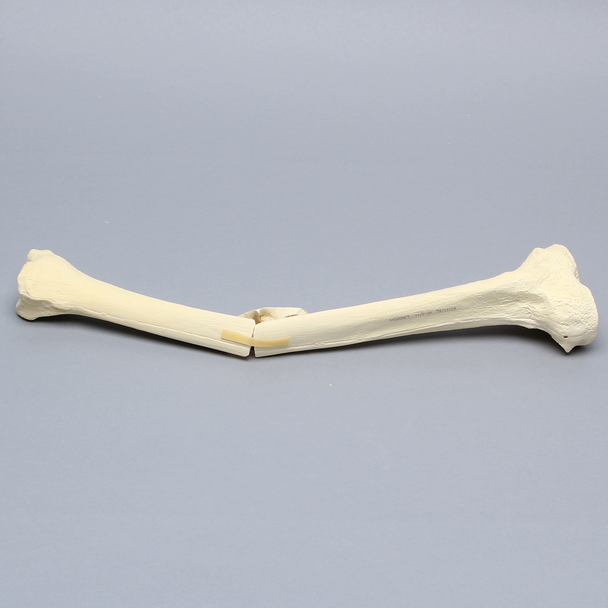 Tibia with Butterfly Fracture