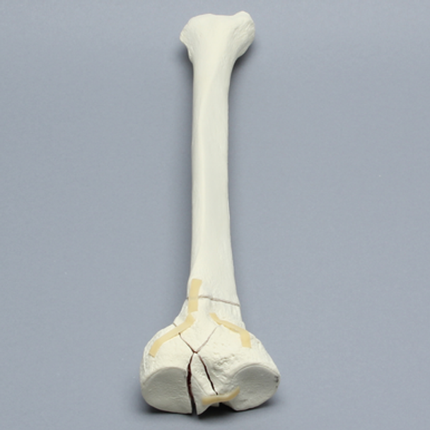 Tibia with Bicondylar and Oblique Fractures