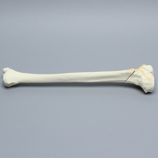 Tibia with Bicondylar and Oblique Fractures